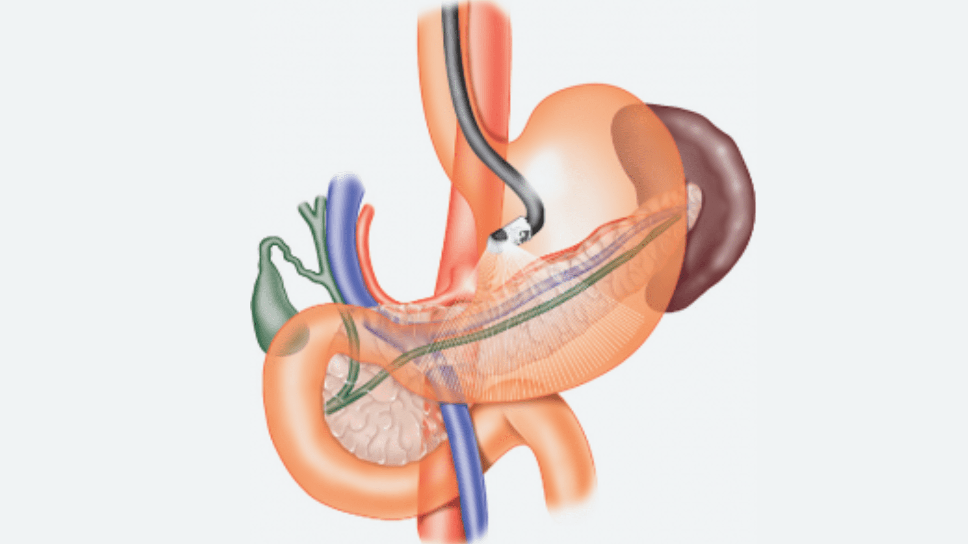 exame de ecoendoscopia