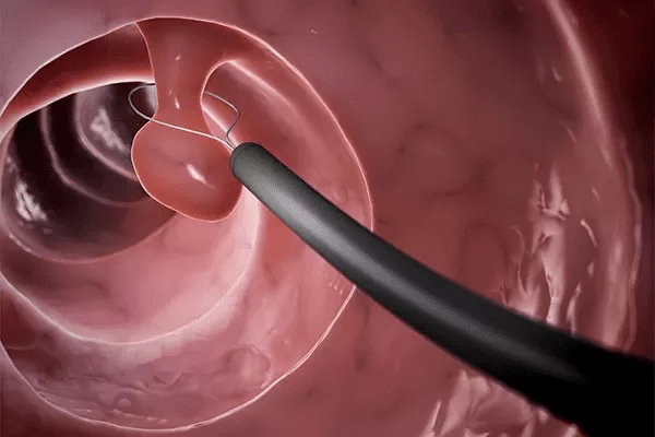 colonoscopia previne câncer de intestino