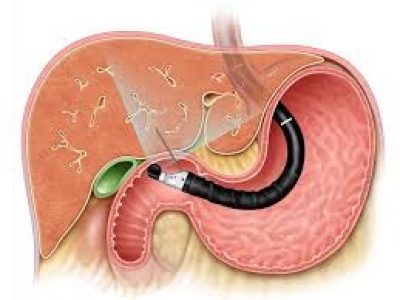 histórico familiar de câncer de pâncreas ecoendoscopia