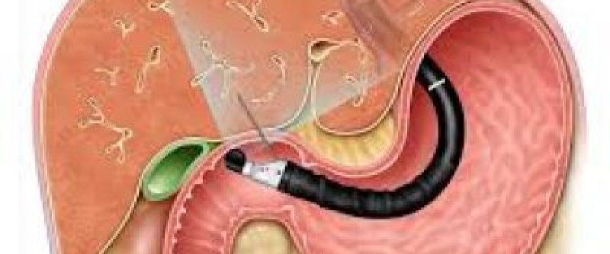 histórico familiar de câncer de pâncreas ecoendoscopia