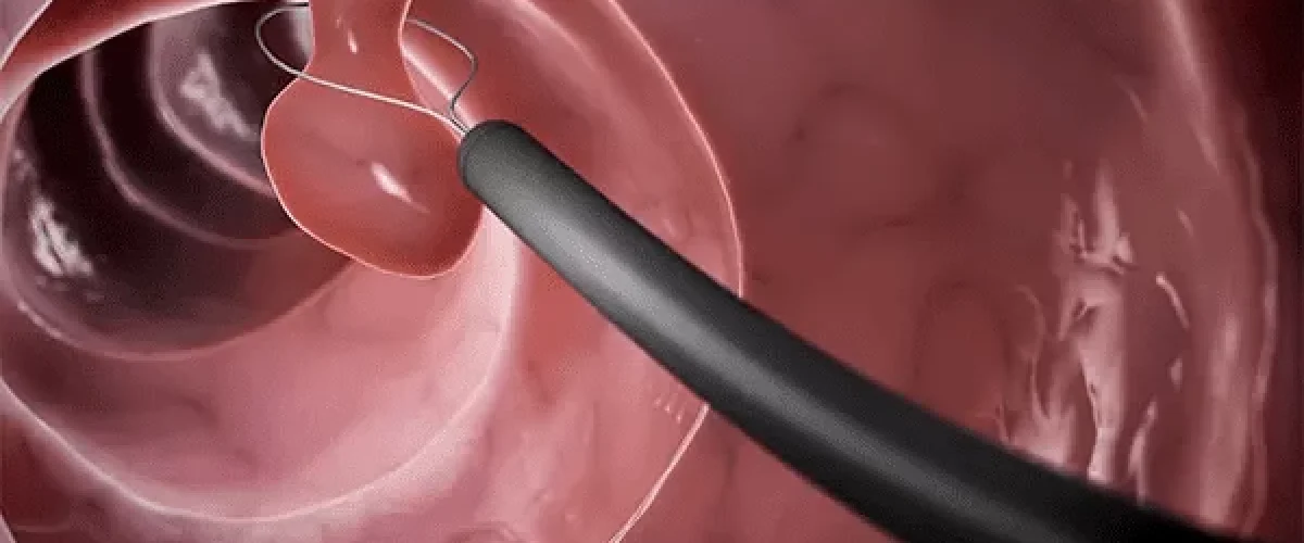colonoscopia previne câncer de intestino