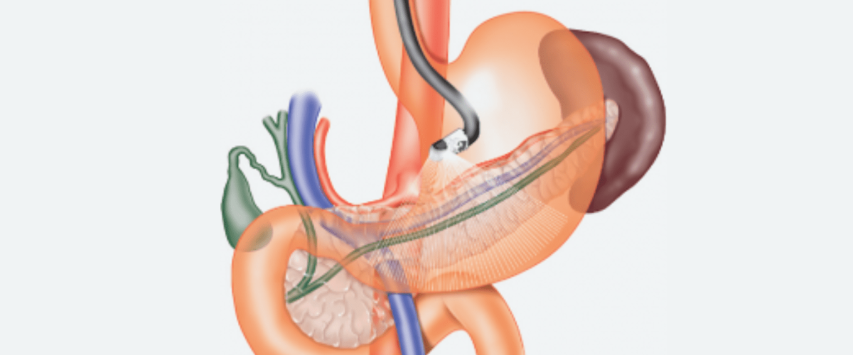 exame de ecoendoscopia