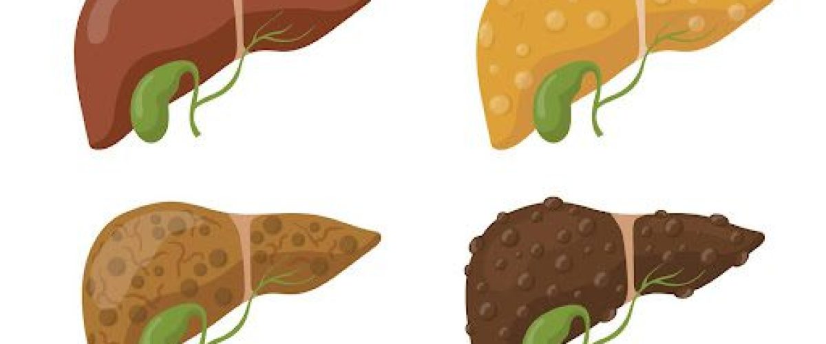 melhor remédio para gordura no fígado